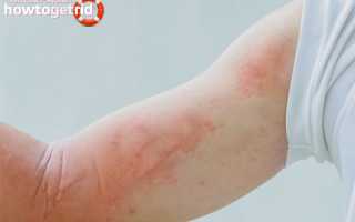 Аллергия на чай: причины, симптомы, лечение