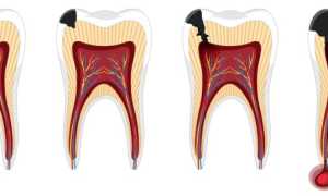 Болят зубы от сладкого: в чем причина и как исправить
