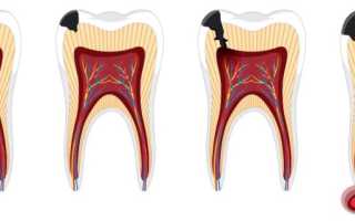 Болят зубы от сладкого: в чем причина и как исправить