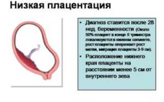 20 неделя низкая плацентация