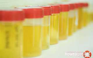 Ацетон в моче у ребенка: симптомы, причины, лечение