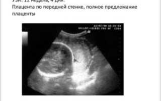 Расположение плаценты по передней стенке в дне
