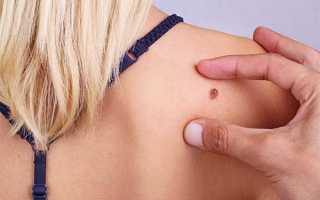 Что такое меланома кожи: причины, симптомы и лечение