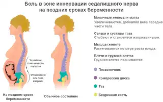 Боли в спине при беременности: что делать?