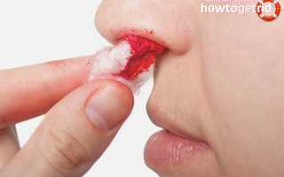 Что делать, если идет кровь из носа: полезные советы