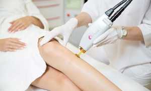 Александритовый лазер для эпиляции