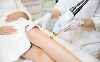 Александритовый лазер для эпиляции