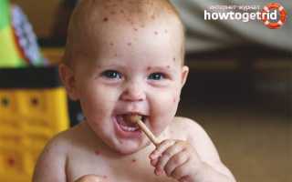 Чем лечить ветрянку у детей кроме зеленки