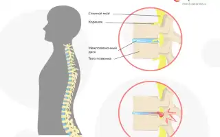 Что такое дорзальная грыжа и как ее лечить?