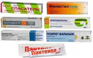 Чем мазать укусы комаров: полезные советы