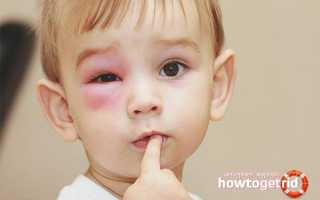 Что делать, если вашего ребенка укусила оса