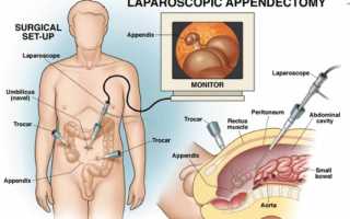 Что из себя представляет операция аппендэктомия?