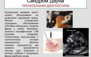 Синдром дауна диагностика при беременности